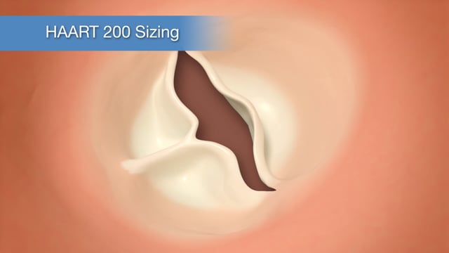 Technique - Sizing - Bicuspid Aortic Valves