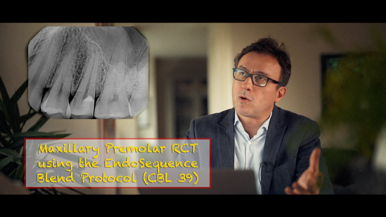 EndoSequence Blend protocol in Premolar (CBL 37) Real World Endo
