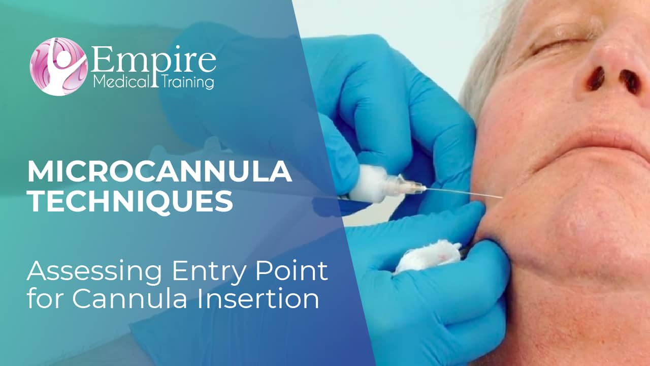 Assessing Entry Point for Cannula Insertion - MICROCANNULA TECHNIQUES ...