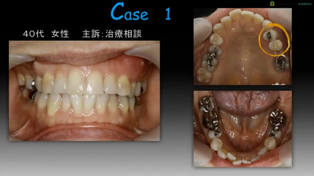 #1 歯周矯正治療の目的
