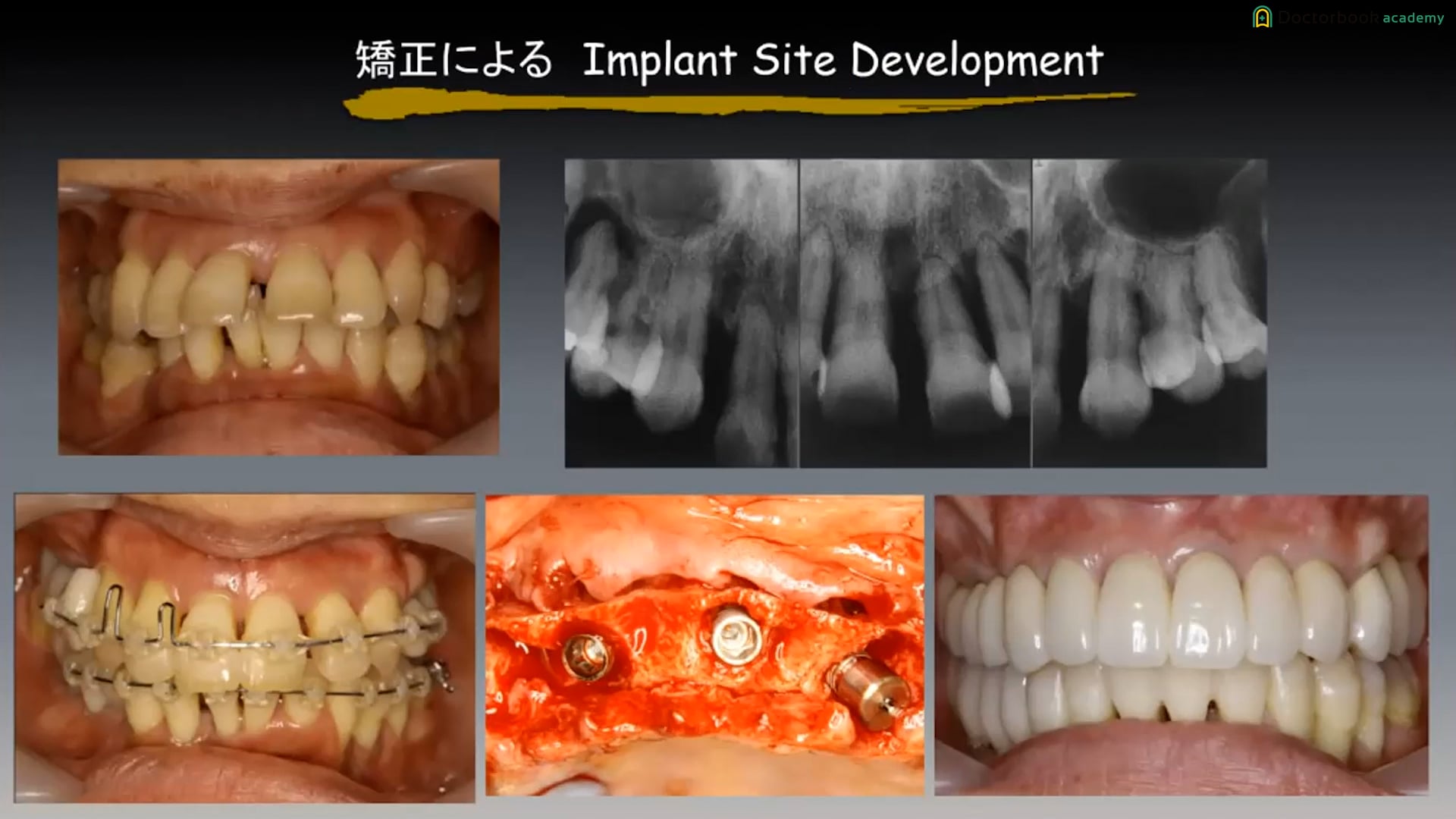 #3 再生治療と矯正治療のタイミングについて