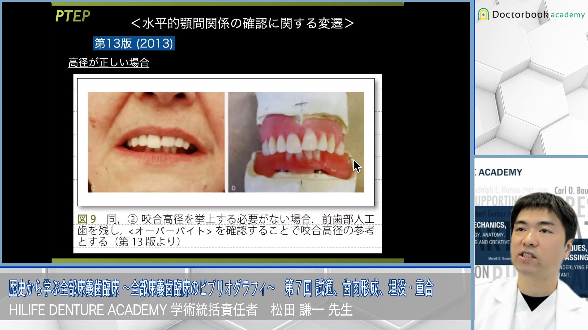 試適、歯肉形成，埋没・重合│歴史から学ぶ全部床義歯臨床 〜全部床義歯臨床のビブリオグラフィ〜 第7回