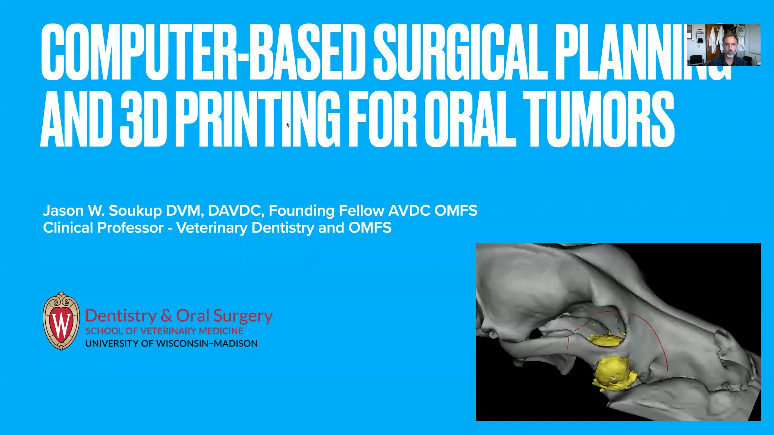 Computer-based surgical planning and 3D printing for oral tumors