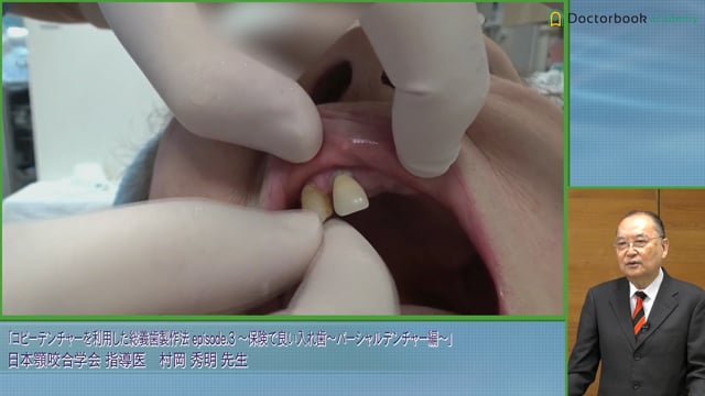 コピーデンチャーを利用した総義歯製作法 .3 保険で良い入れ歯