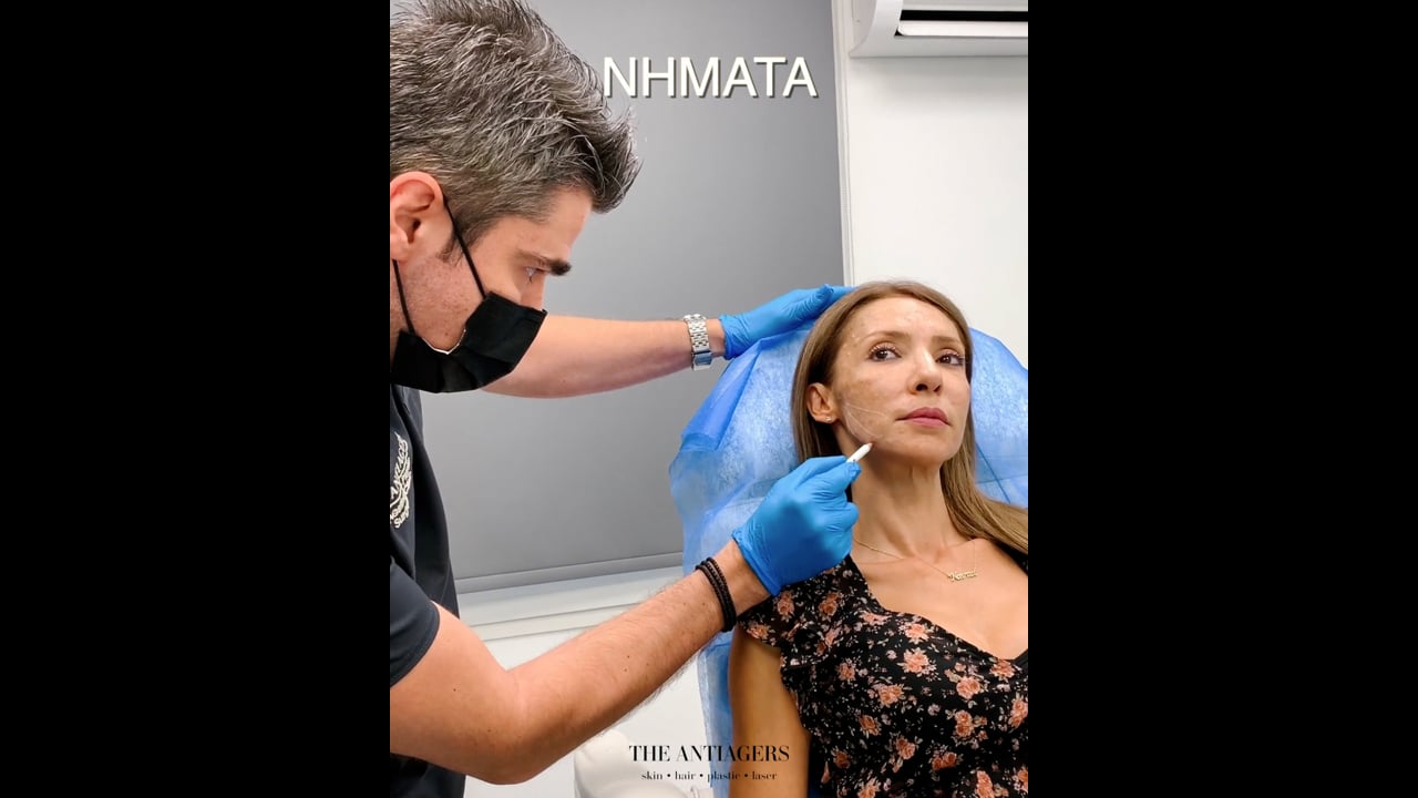 3πλή Αντιγηραντική Θεραπεία: Botox + Μεσοθεραπεία + Νήματα