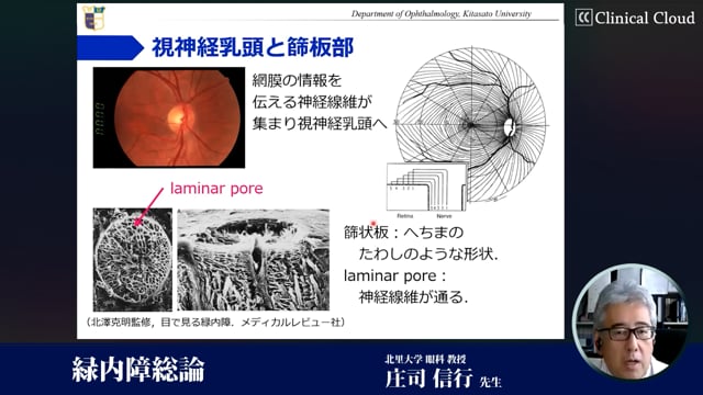 緑内障が疑われたら ～検査・診断・治療を総ざらい～ Part1 | Clinical 