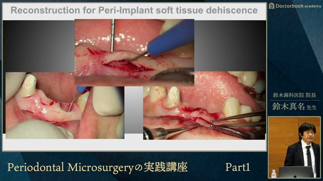 応用編2「Management of Peri-implant Soft Tissue