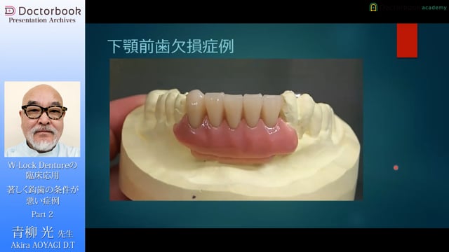 W-Lock Dentureの臨床応用 | Doctorbook academy (ドクター