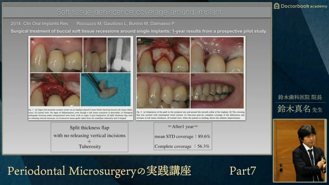 #7 インプラント周囲への結合組織を用いた再建について