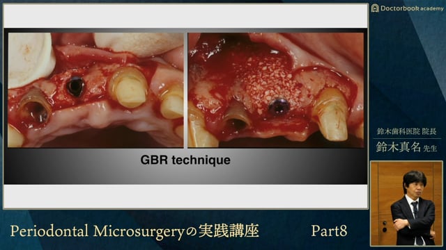 応用編2「Management of Peri-implant Soft Tissue（インプラント周囲 