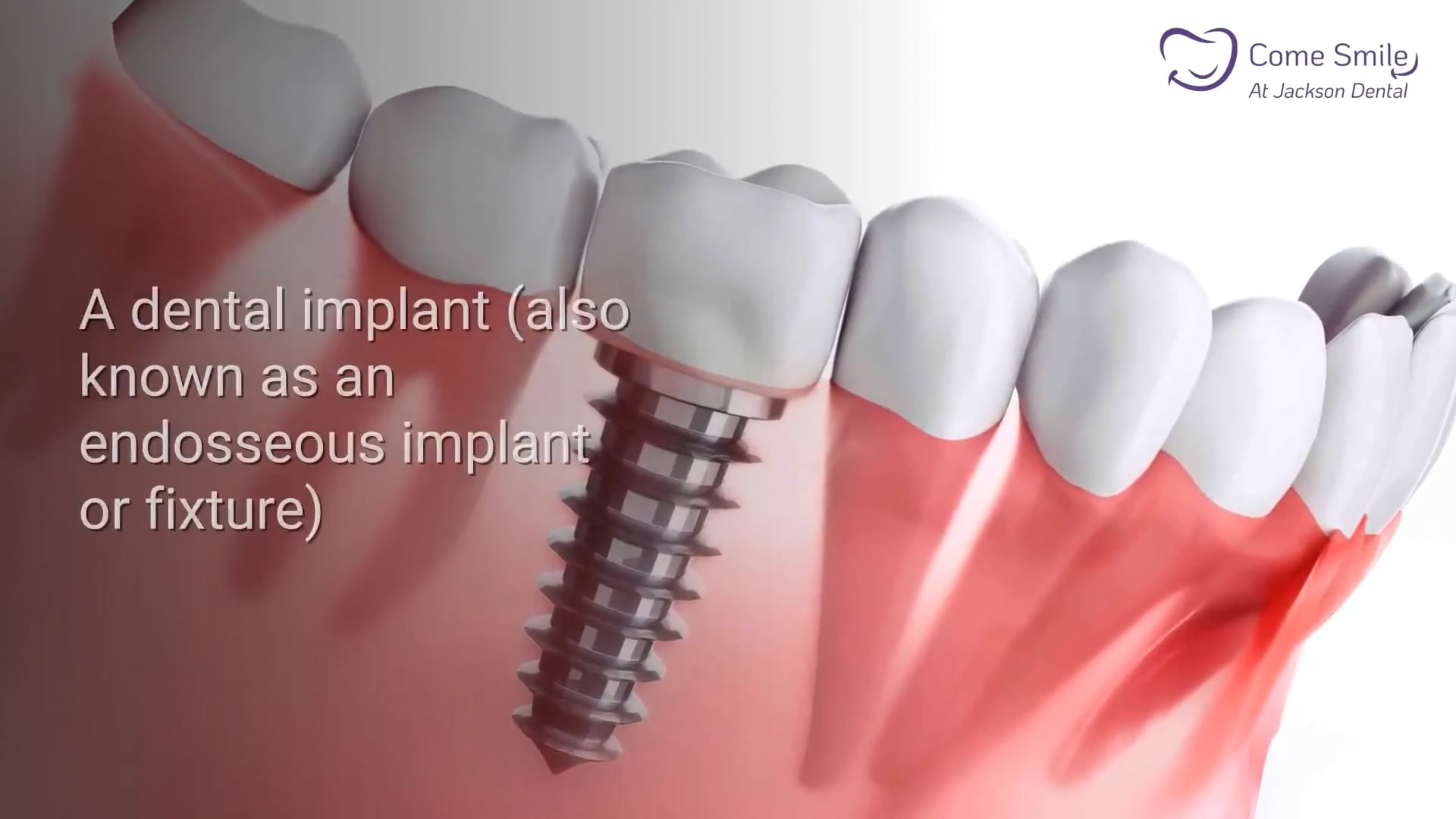 Affordable Dental Implants New Jersey on Vimeo