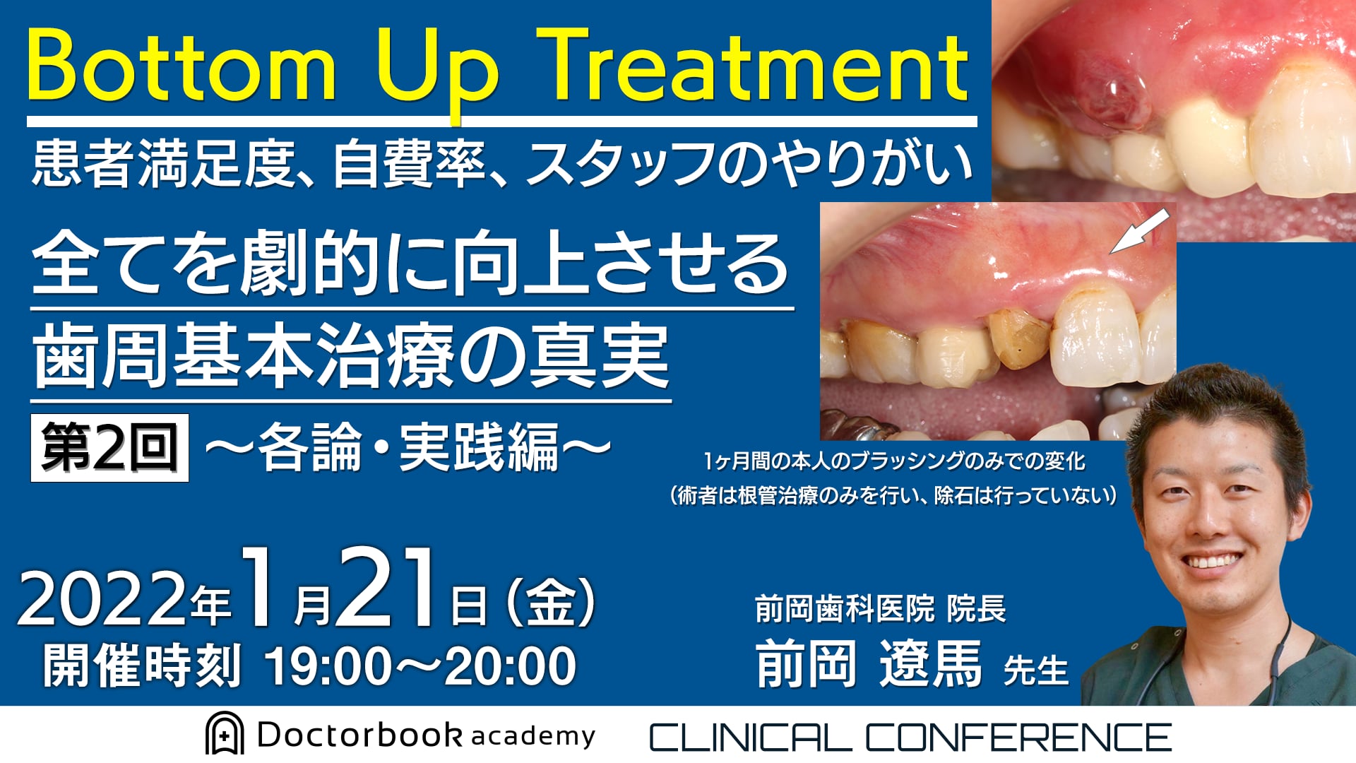 Bottom Up Treatment　患者満足度、自費率、スタッフのやりがい　全てを劇的に向上させる歯周基本治療の真実　第2回～各論・実践編～