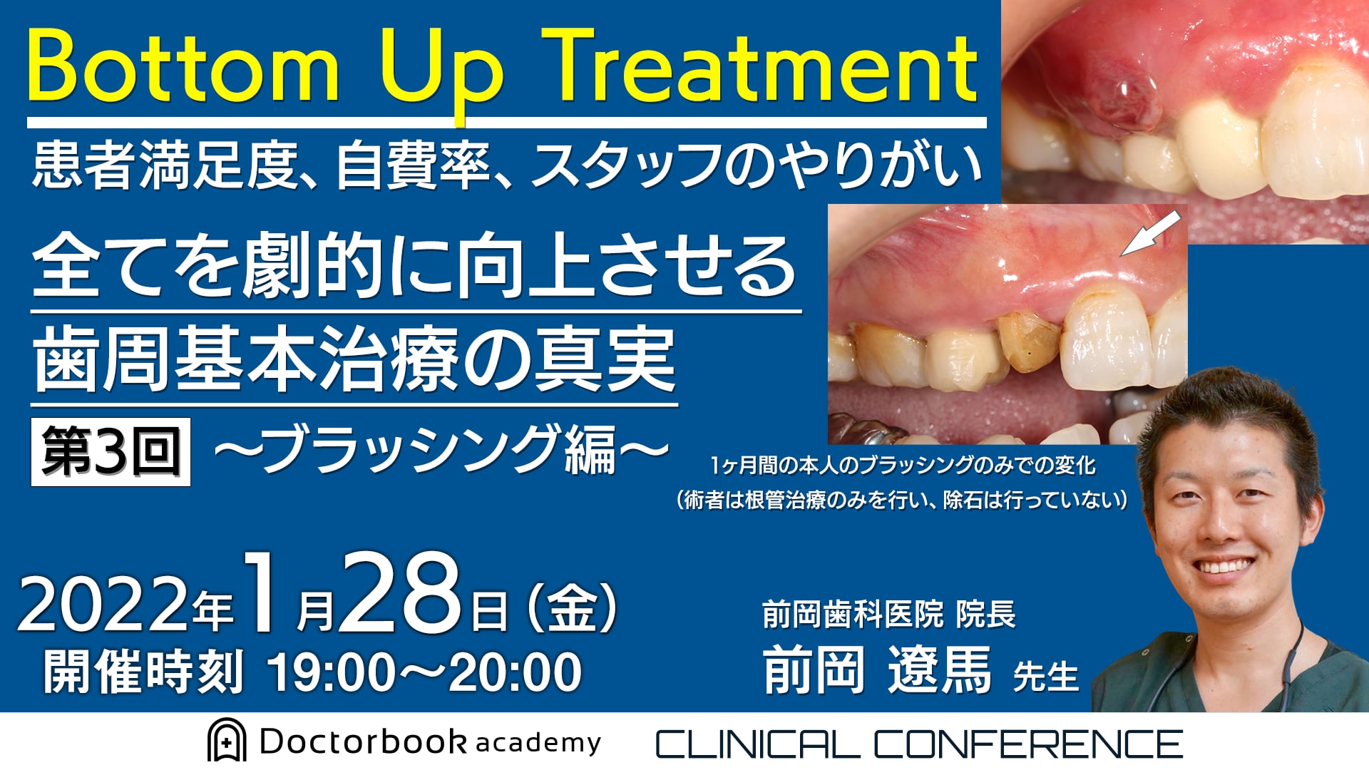 Bottom Up Treatment　患者満足度、自費率、スタッフのやりがい　全てを劇的に向上させる歯周基本治療の真実　第3回～ブラッシング編～