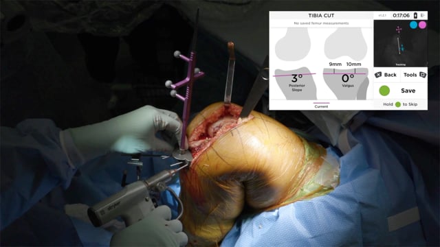 Primary Total Knee Arthroplasty Using Imageless Computer-Assisted Navigation | Dr. Meftah