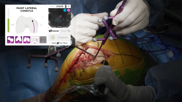 Primary Total Knee Arthroplasty Using Imageless Computer-Assisted Navigation | Dr. Schwarzkopf