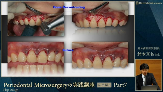 応用編3「 Flap Design（フラップデザイン）」 | Doctorbook academy 