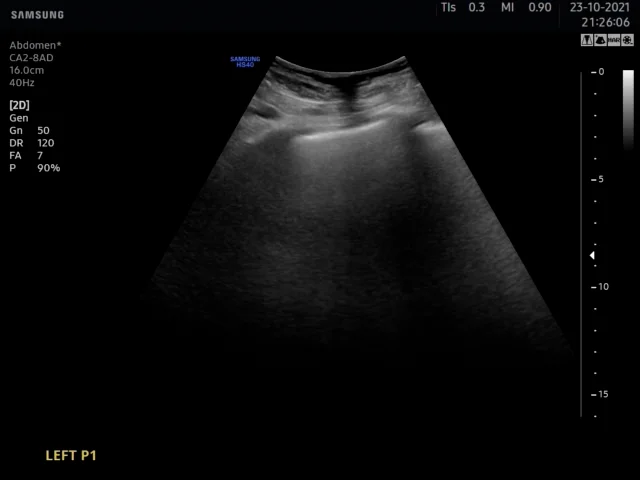 A) A brightness mode (b-mode) image of the lateral abdominal wall.