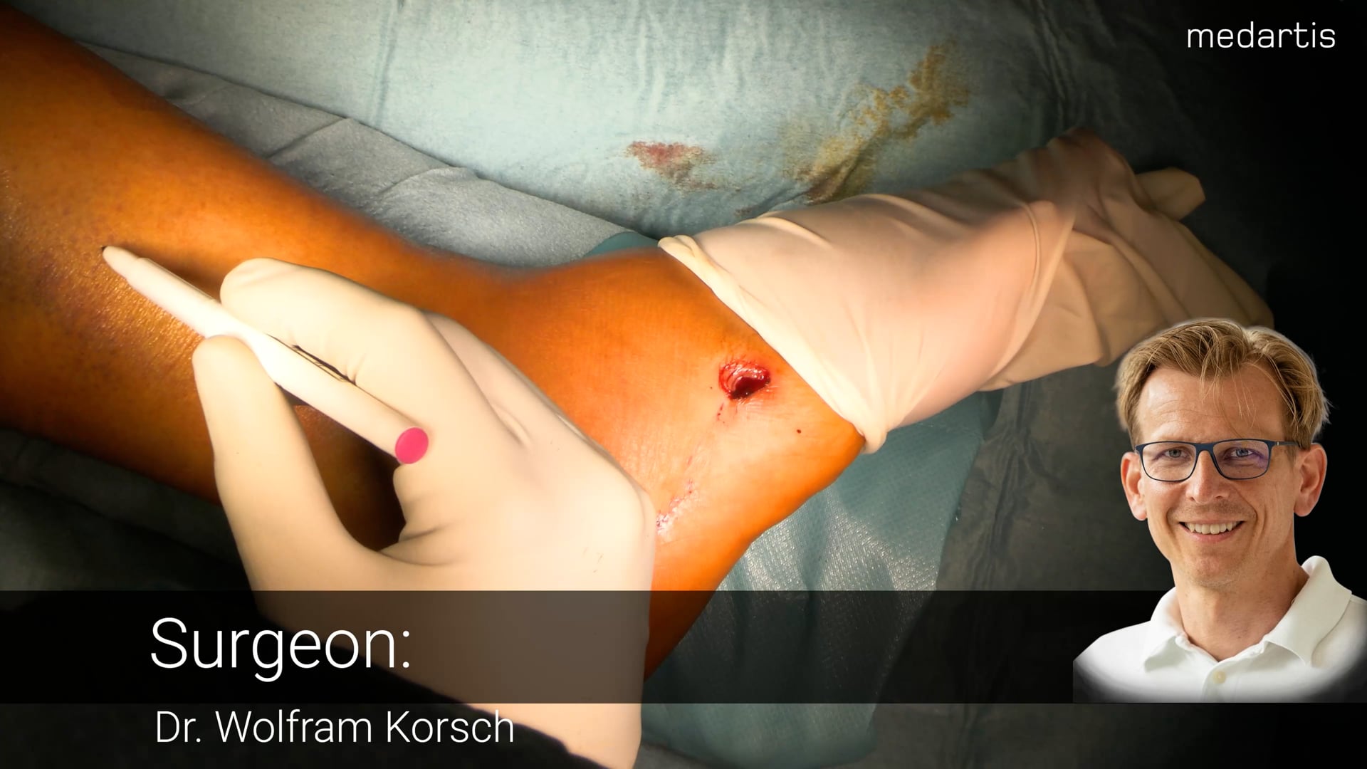 Trimalleolar Ankle Fracture