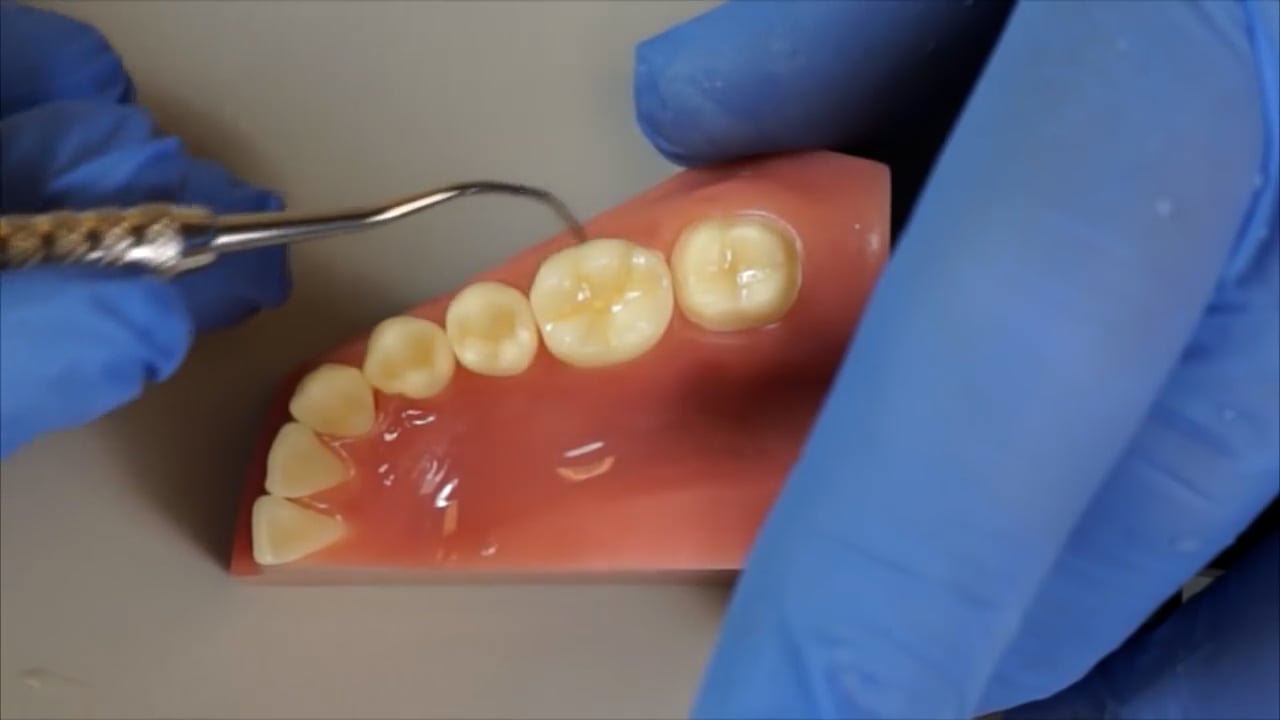 Zirconia Crown Cementation Insure Resin Cement on Vimeo