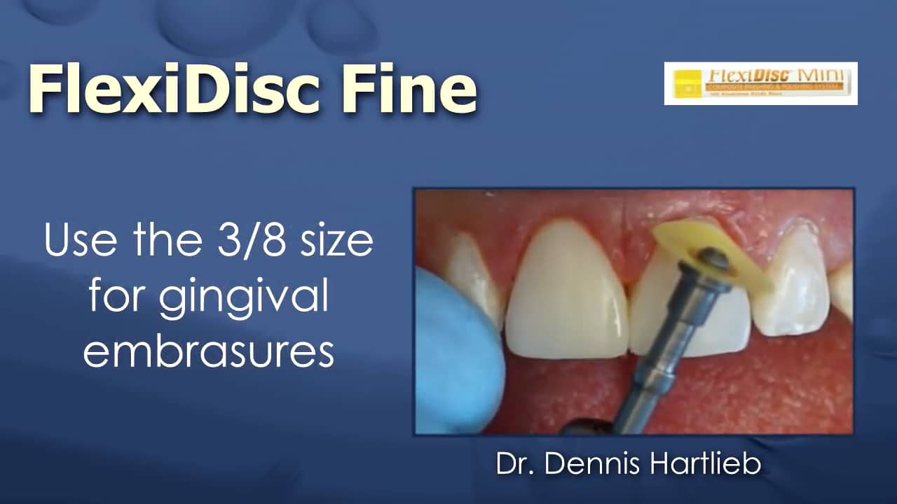 Finishing and Polishing Composite Restorations on Vimeo