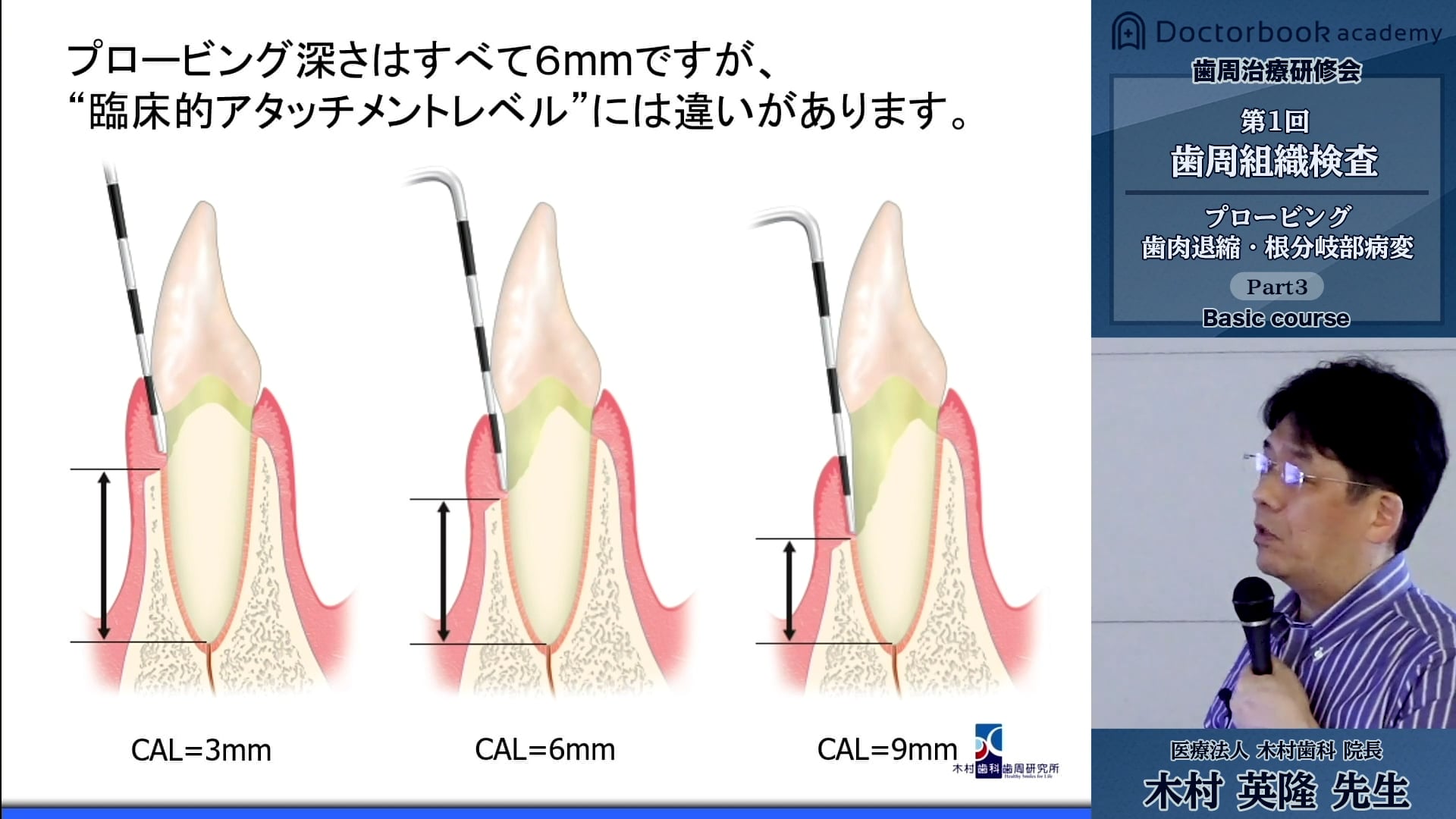 #3 臨床的アタッチメントレベルと根分岐部病変