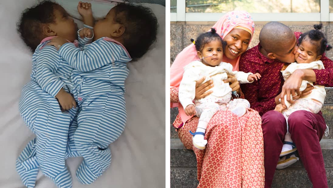 Inside The Successful Separation Surgery Of Conjoined Twins