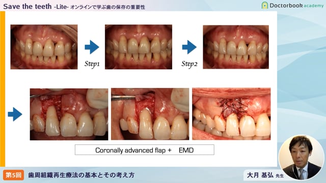 【オンデマンド】Save the teeth−Lite−オンラインで学ぶ歯の保存の重要性 「 第五回：歯周組織再生療法の基本，考え方」