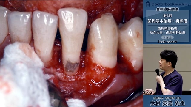 #1 歯周基本治療の再評価