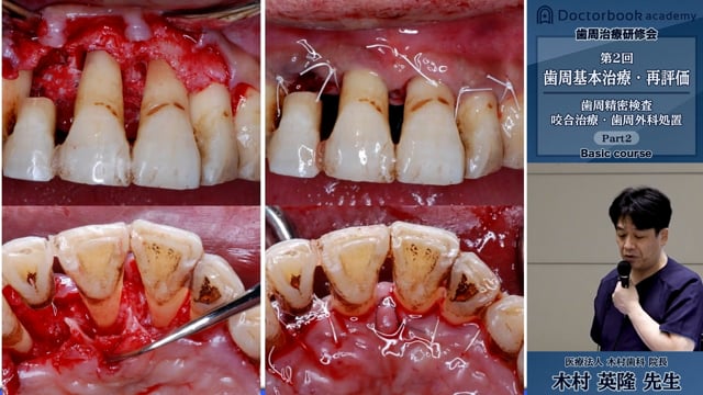 #2 歯周外科手術による動揺度