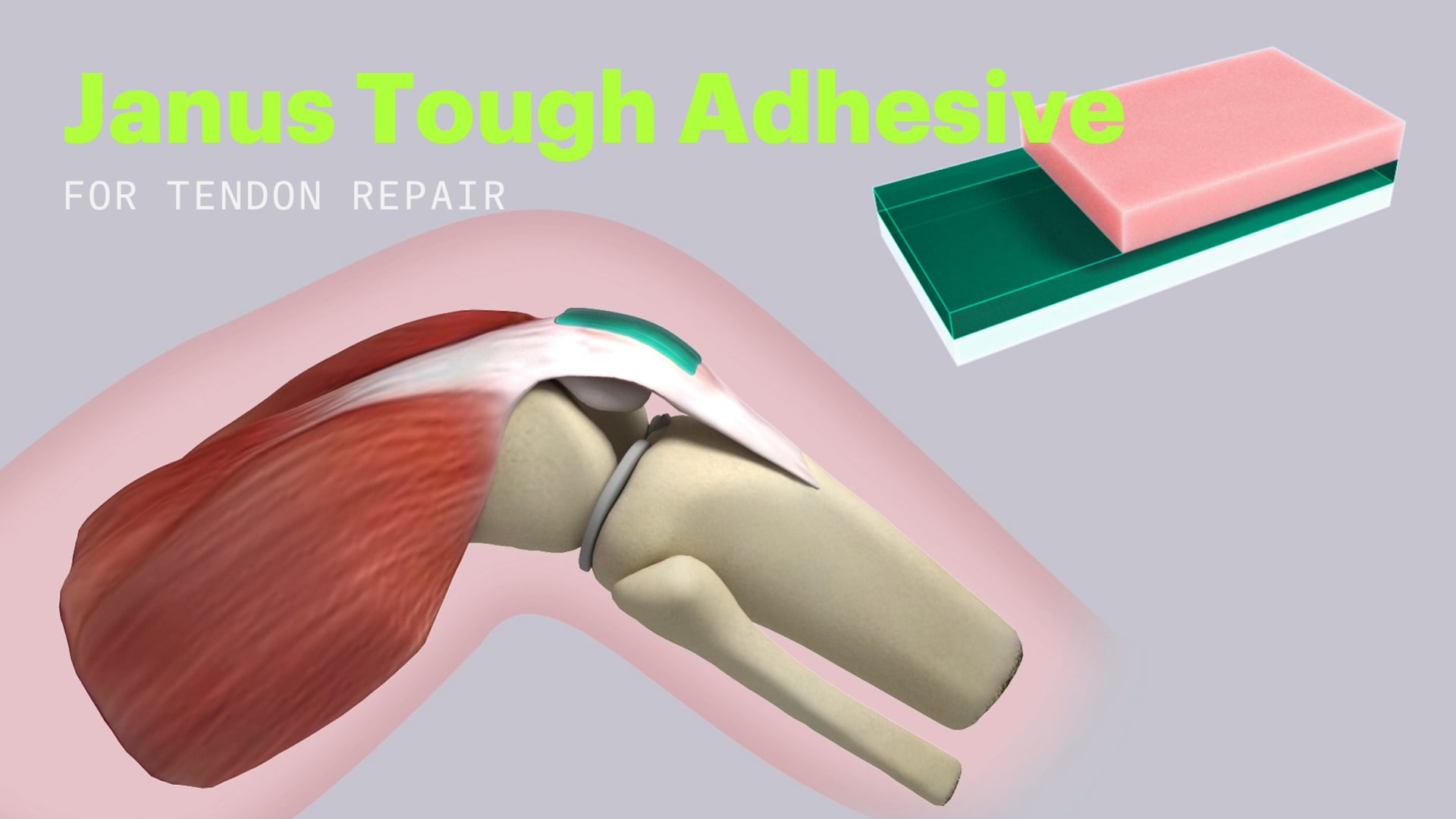 Janus Tough Adhesives for Tendon Repair