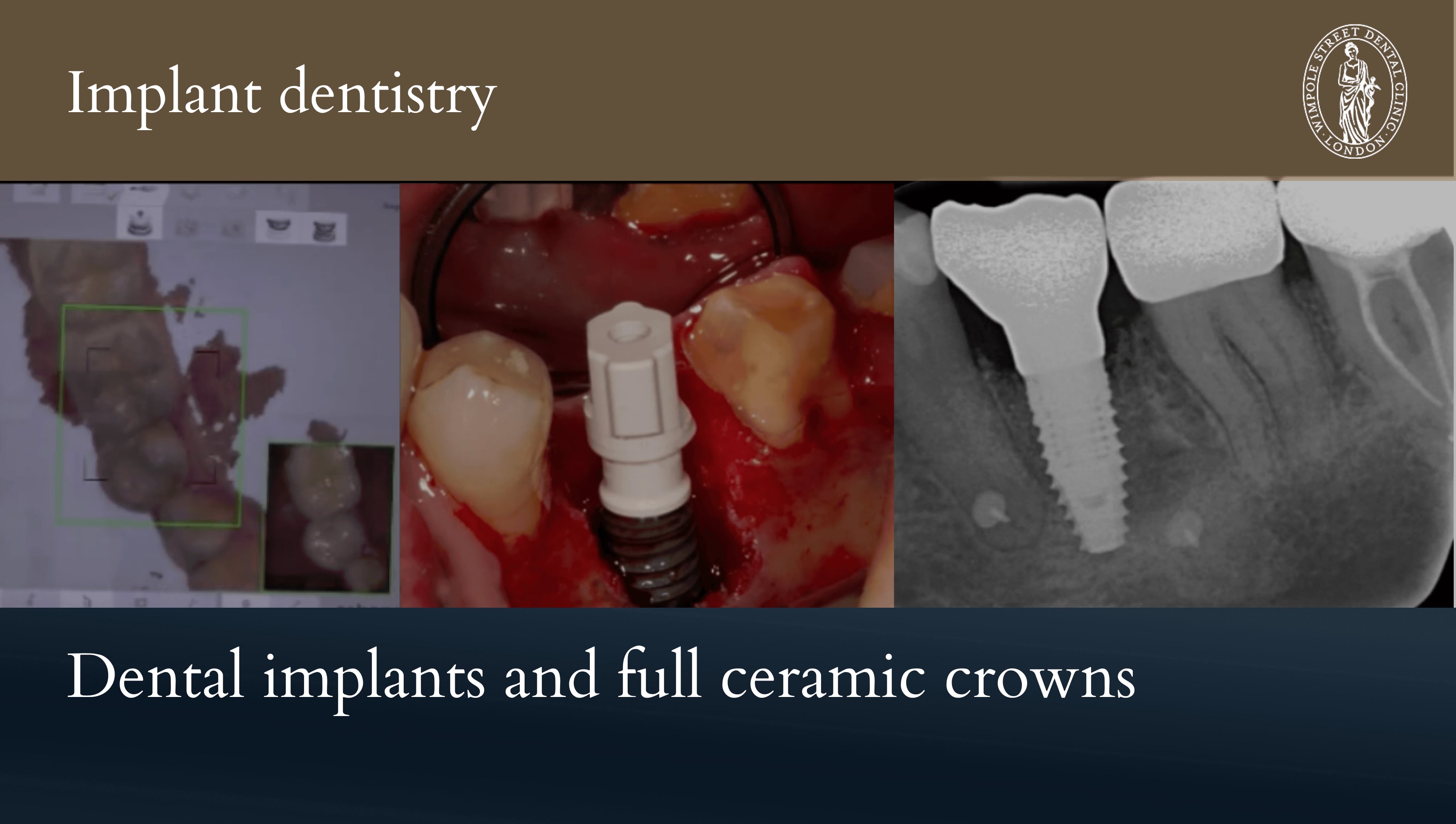 Implant Case 6 - replacing cracked molars with implants and full ...