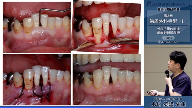 #1 歯肉剝離搔把術の適応禁忌