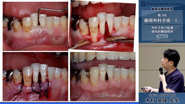 歯周治療研修会ベーシックコース 第3回「歯周外科手術 -1