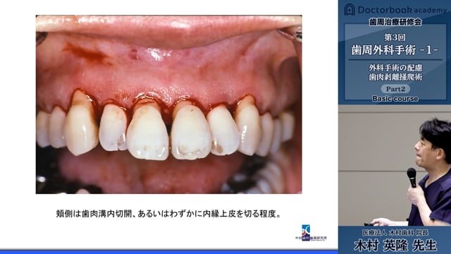 歯周治療研修会ベーシックコース 第3回「歯周外科手術 -1