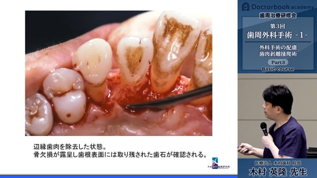 歯周治療研修会ベーシックコース 第3回「歯周外科手術 -1