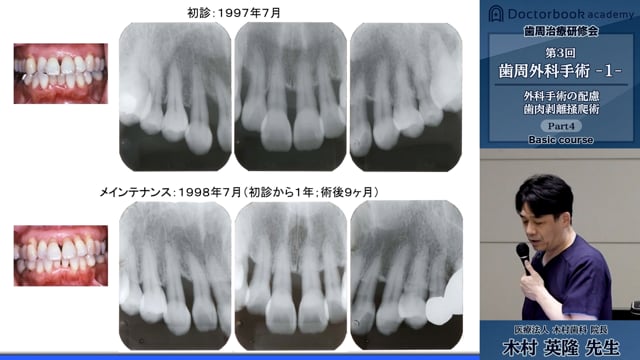 歯周治療研修会ベーシックコース 第3回「歯周外科手術 -1