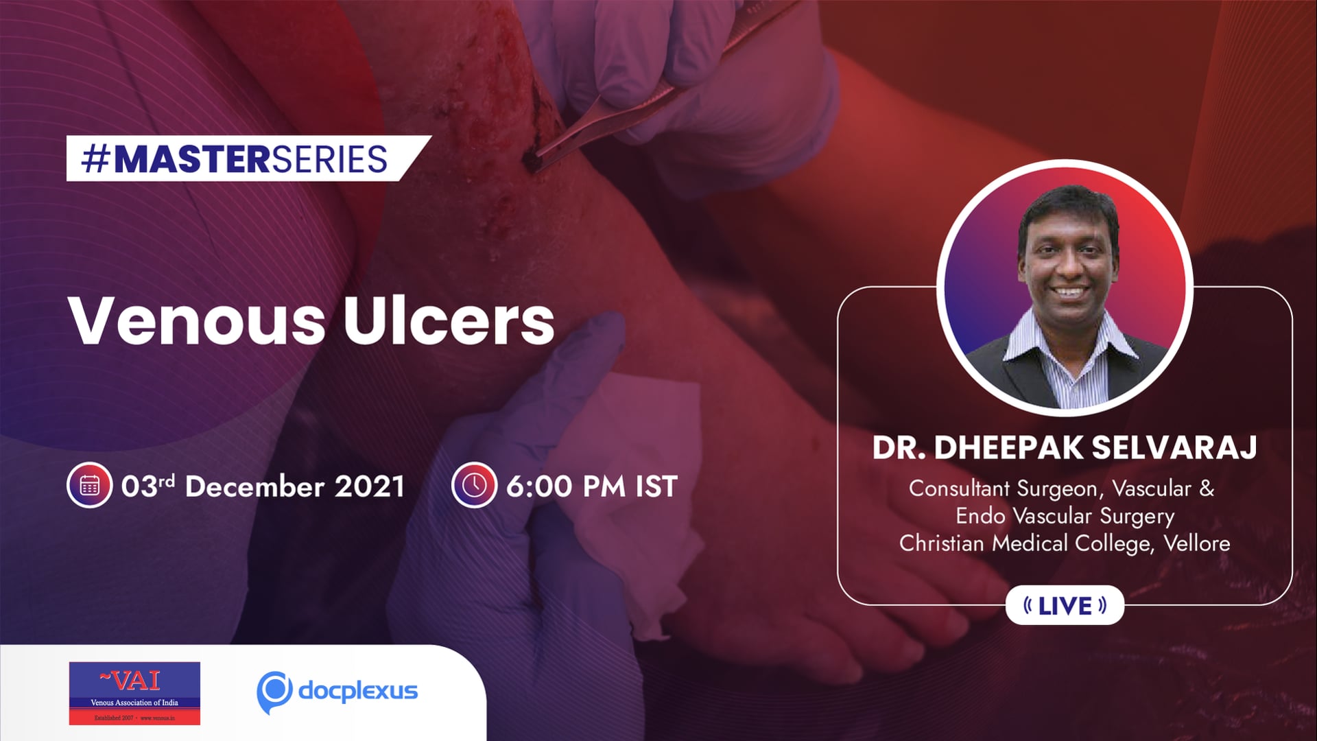 Venous Ulcers