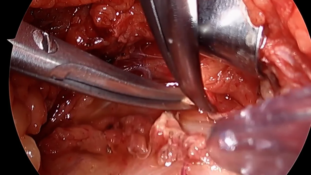 Subxiphoid Pericardial Window: Steps and Helpful Tips | CTSNet