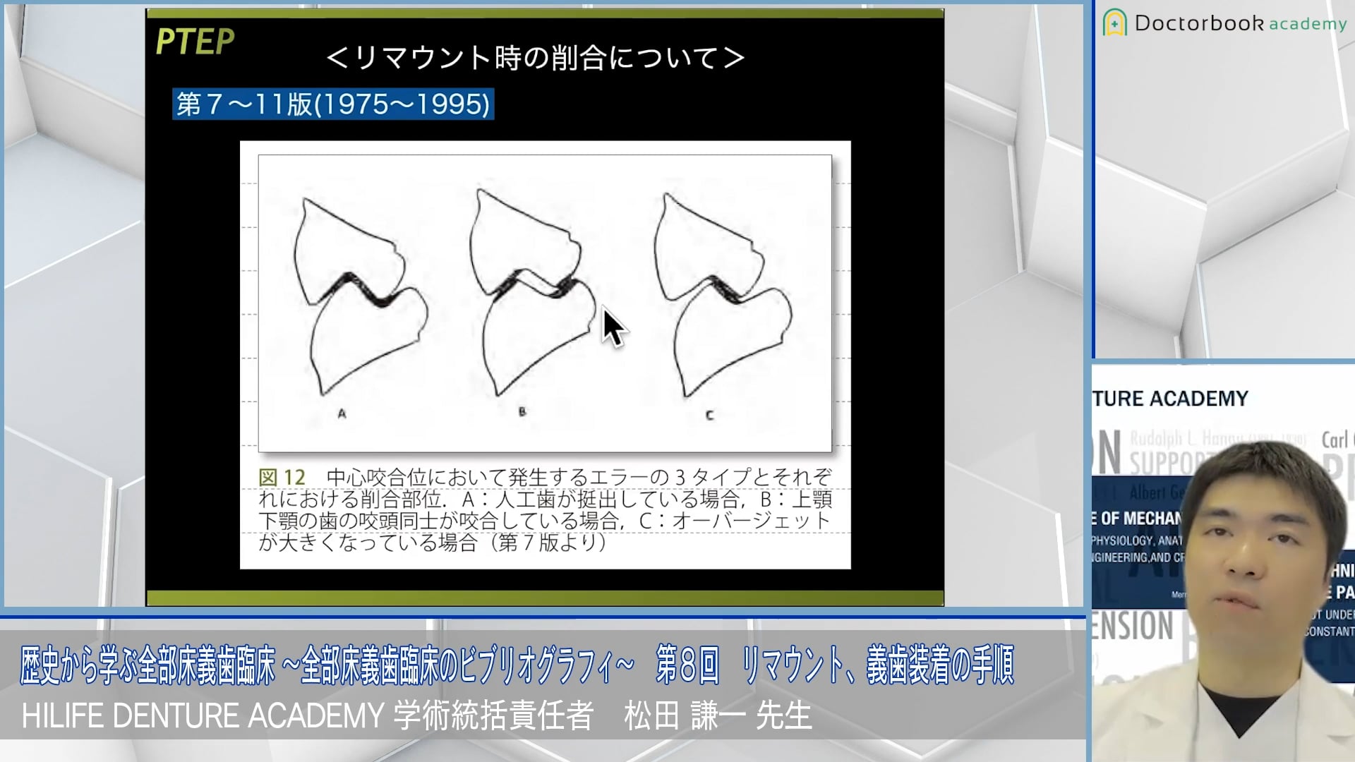 リマウント、義歯装着の手順│歴史から学ぶ全部床義歯臨床 〜全部床義歯臨床のビブリオグラフィ〜 第8回