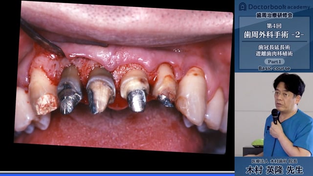#1 歯冠長延長術と根尖側移動全層弁歯肉剥離搔把術 