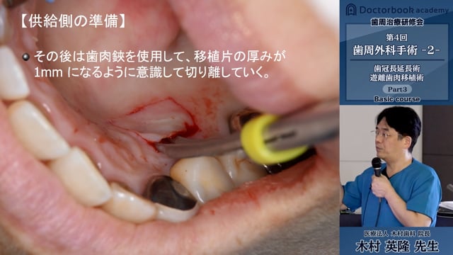 Surgical Basic Course 歯周形成外科コース（DVD版）第二回-