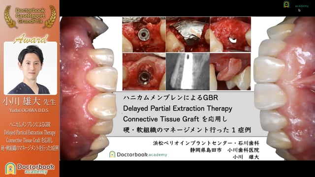 ハニカムメンブレンによるGBR  Delayed Partical Extraction Therapy  Connective Tissue Graft を応用し硬・軟組織のマネージメントを行った1症例