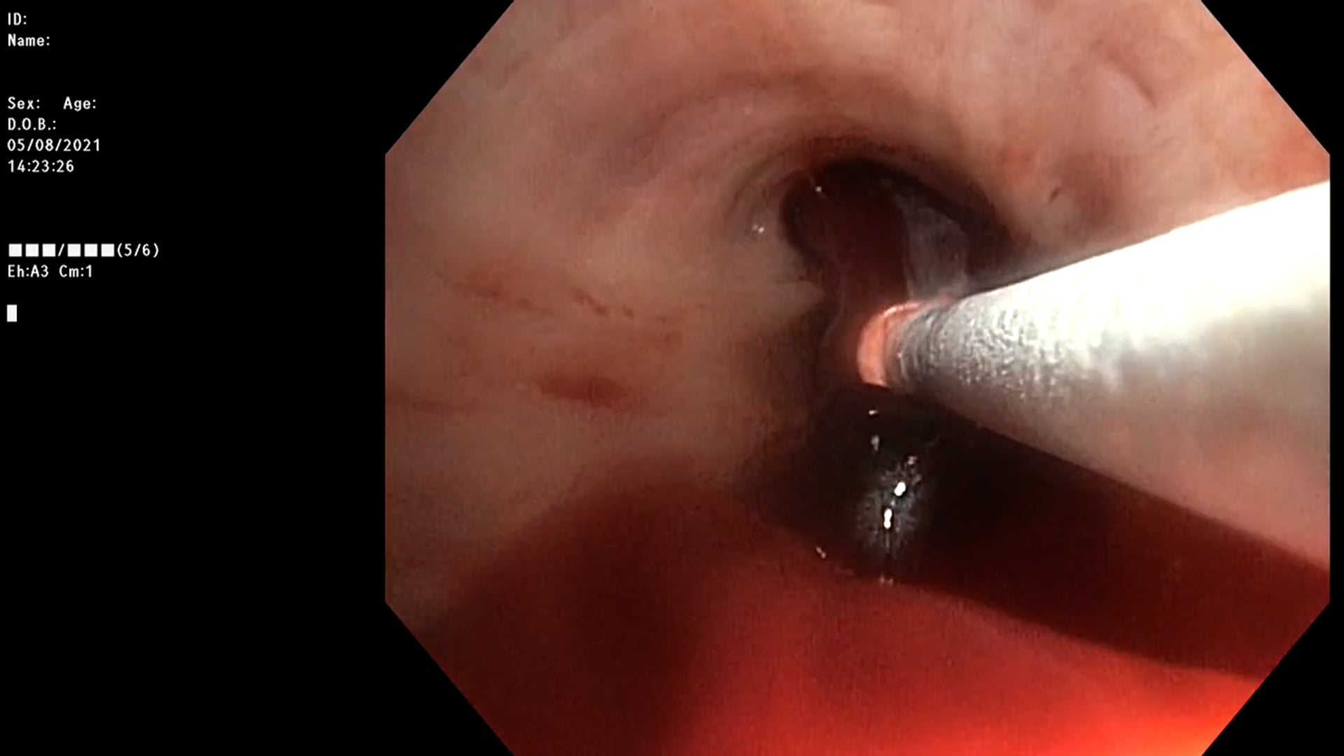 Blood clot cryoextraction of a large central cast in piecemeal-technique using the 1.7mm probe
