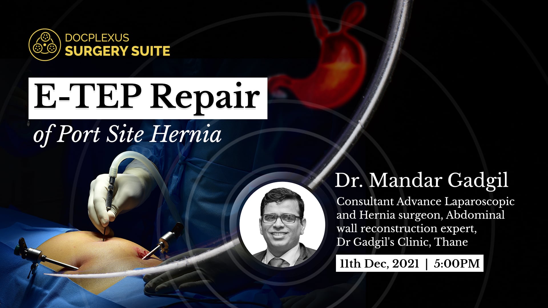 E-TEP Repair of Port Site Hernia