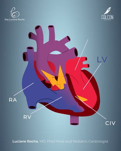 Dupla Via de Saida de Ventriculo Direito (DVSVD) com CIV duplamente ...
