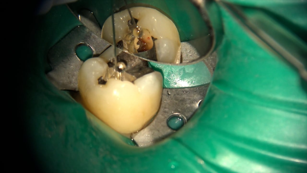 Real World Endo | Endodontics Educational Videos - World Class ...