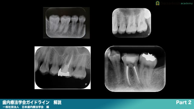 『歯内療法学会ガイドライン』解説 Part2