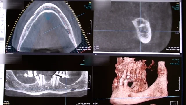 cheratocisti odontogena