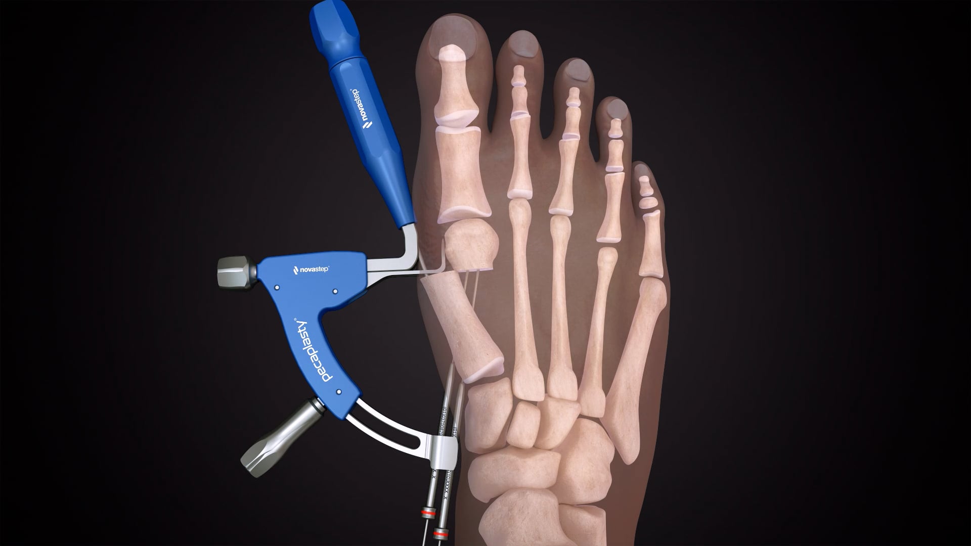 chirurgie percutané hallux valgus