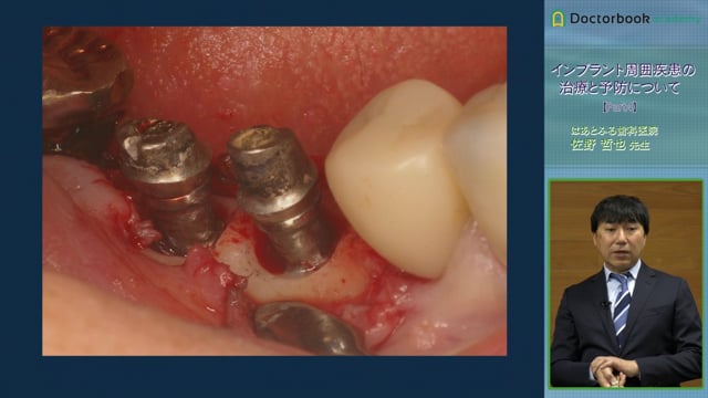 インプラント周囲疾患の治療と予防について | Doctorbook academy